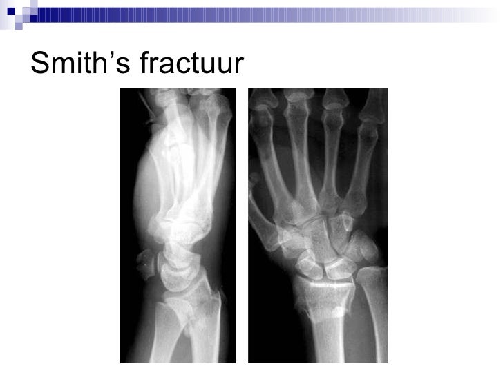 smith fractuur